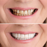 Instant Smile Veneers