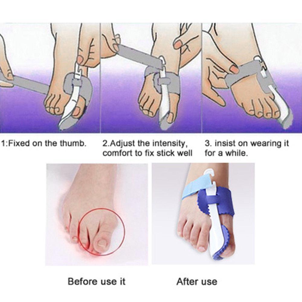 Splint Corrector Device