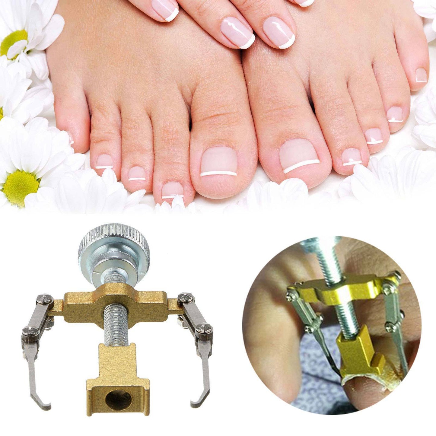 Ingrown Toenail Corrector