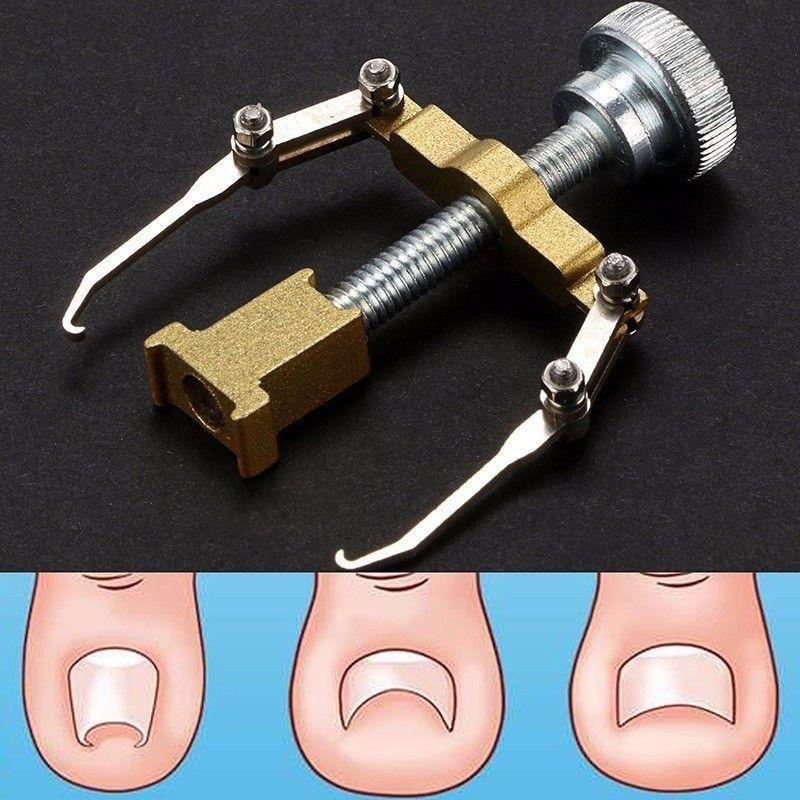 Ingrown Toenail Corrector