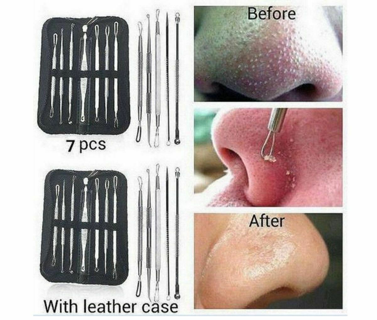 7 Piece Acne Removal Kit