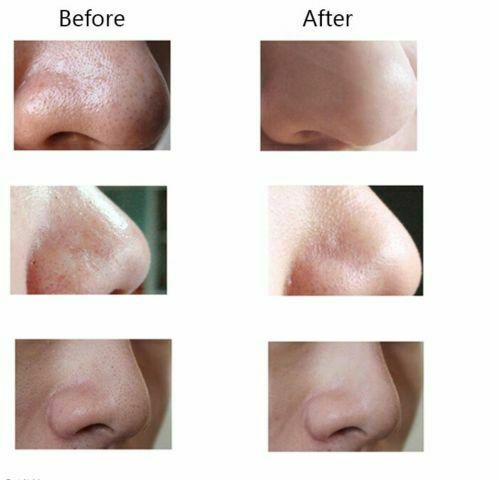 Blackhead Remover Vacuum