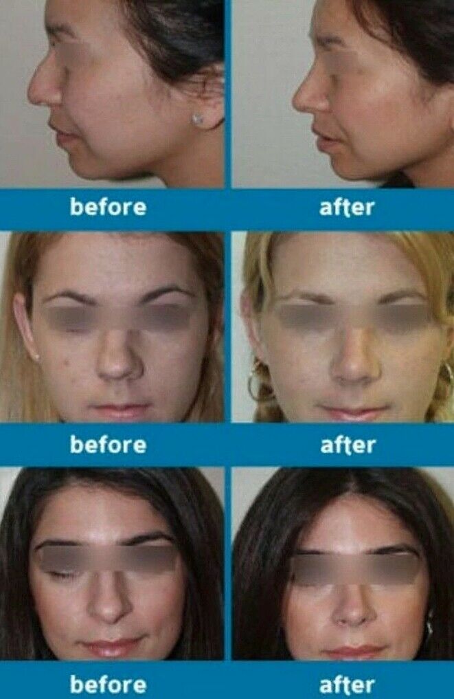 Nose Corrector Clip