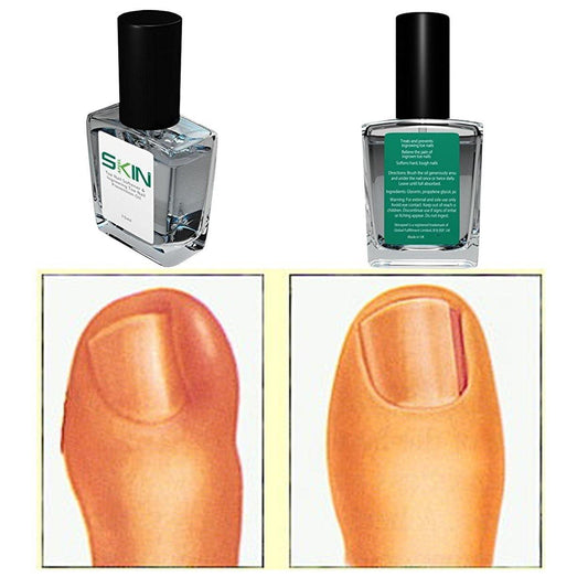 Toe Nail Softener - Direct Savings Online 