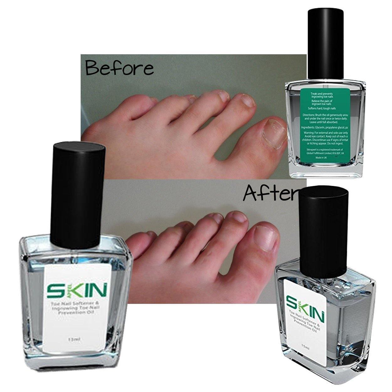 Toe Nail Softener - Direct Savings Online 